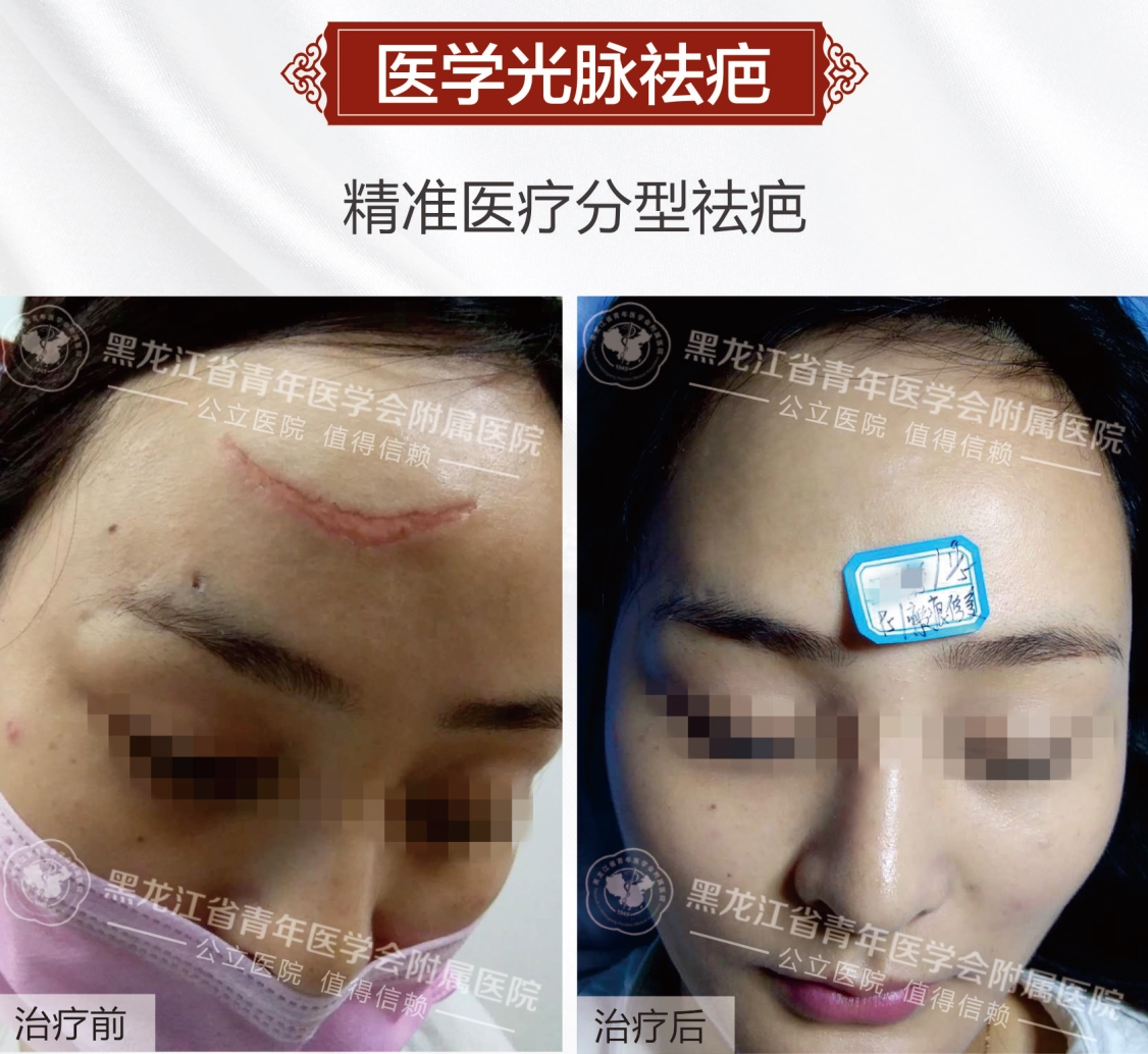 昆明皮肤病医院怎么快速消除疤痕?